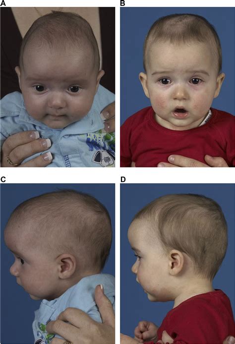 Analysis Of The Cephalometric Changes In The First Months After