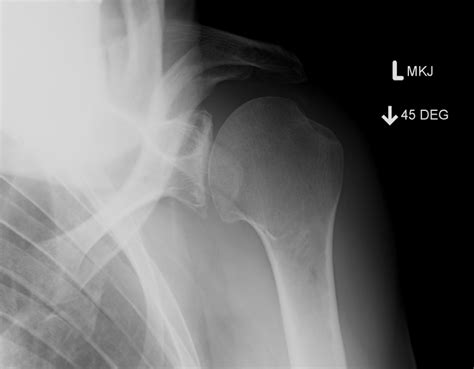 Shoulder Xrays The Bone School