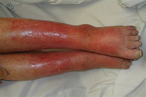 Cellulitis Medlibes Online Medical Library