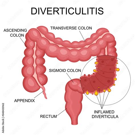 Diverticulitis And Diverticulosis Vector Illustration Medical Structure And Location