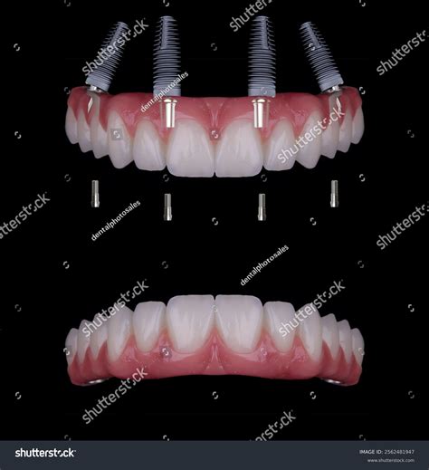 Dental Implant Treatment Applied Edentulous Jaws Stock Photo 2562481947