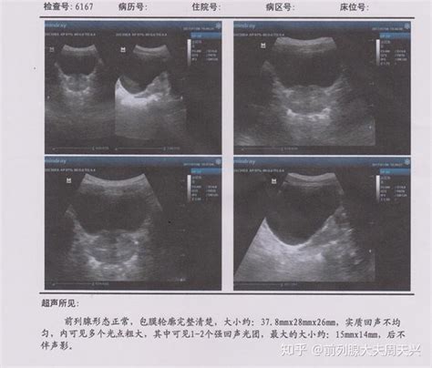 停止治疗三年，他的前列腺病情会发展成什么样？ 知乎