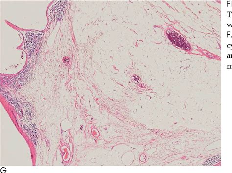 Figure 1 From Findings Of Angiomyolipoma With Epithelial Cysts Of The