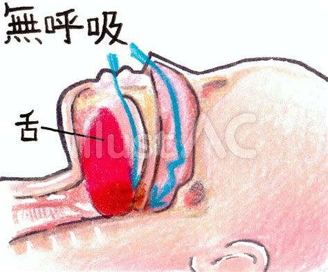 Free Vectors | Causes of sleep apnea