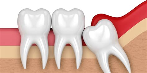 Wisdom Tooth Extraction in Gurgaon - White Smile Dental Care