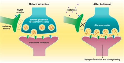 Resetting The Brain And Mind With Ketamine Kathleen Hanagan