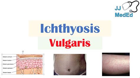 Inherited Ichthyosis And Fungal Infection: An Update On, 55% OFF