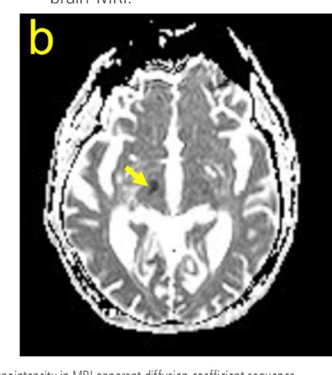 Figure From Comparison Of Hemichorea Hemiballism Between Acute Stroke