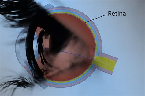 Blue Light Filter Macular Degeneration Shelly Lighting