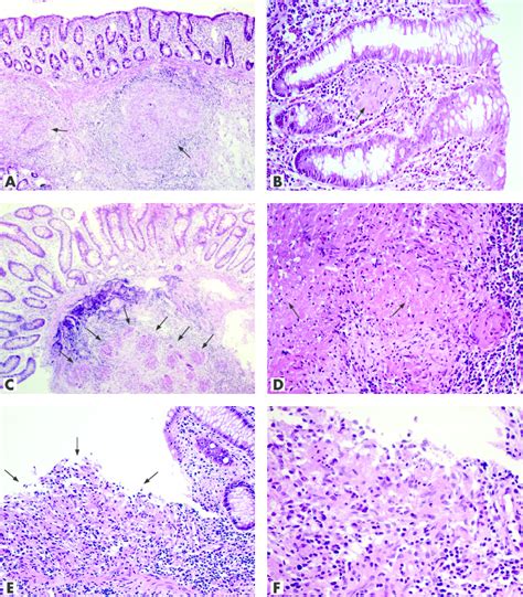 Colonic Biopsy Specimens From Patients With Disease Stained With Download Scientific Diagram