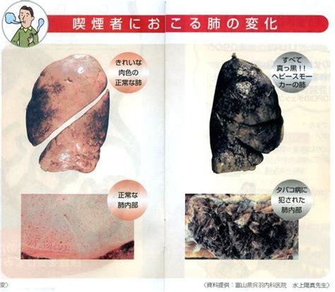 10copd（タバコ病）→禁煙外来 眞弓循環器科クリニック