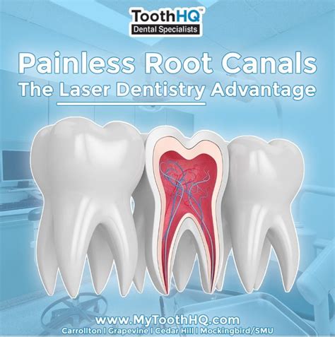 Painless Root Canals The Laser Dentistry Advantage By Mytoothhq Medium