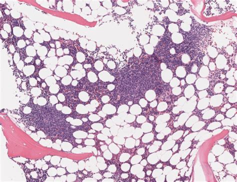 Descripci N De La Biopsia De La Medula Osea Flashcards Quizlet