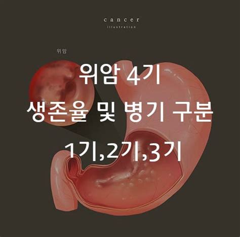 위암 4기 생존율 및 병기 구분 1기2기3기 네이버 블로그