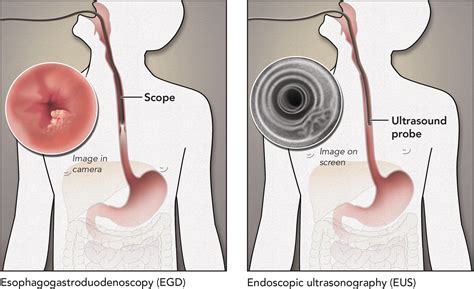 Evelyn Pence - Esophagectomy