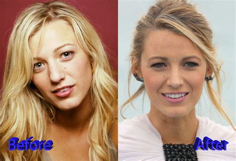 Blake Lively Nose Job: A Slight Change