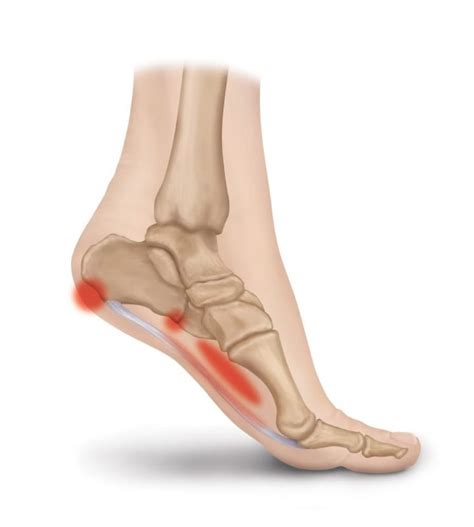 Understanding Plantar Fasciitis Causes Symptoms Treatment And