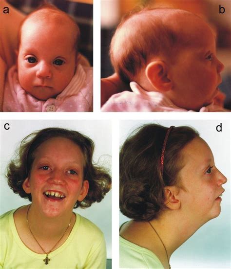 Dysmorphic feature - Alchetron, The Free Social Encyclopedia