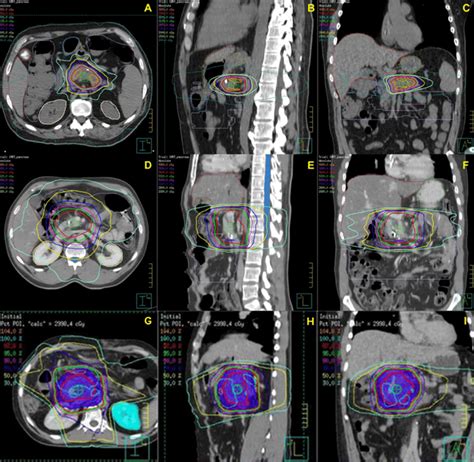 SBRT, IMRT, and 3D-CRT treatment plans. Modern conformal radiation ...