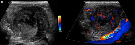 Perforated Appendix Ultrasound