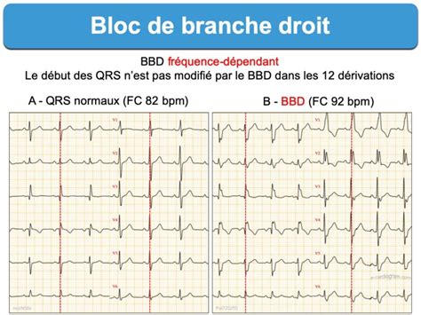 Bloc De Branche Droit Complet E Cardiogram