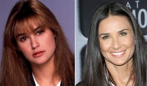 Demi Moore Before And After Plastic Surgery