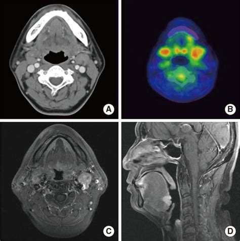 Image Findings A Neck Computed Tomography Ct Contrast Enhanced Download Scientific Diagram