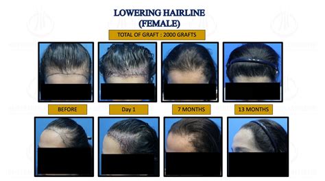 Fue Hair Transplant Li Ads Hair Transplant Centre Malaysia