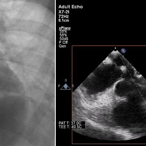 ASD model. (a) Echo imaging of the ASD; (b) gross imaging of the ASD ...