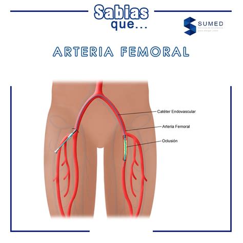 Sumed De M Xico On Twitter Sabiasque La Arteria Femoral Es La