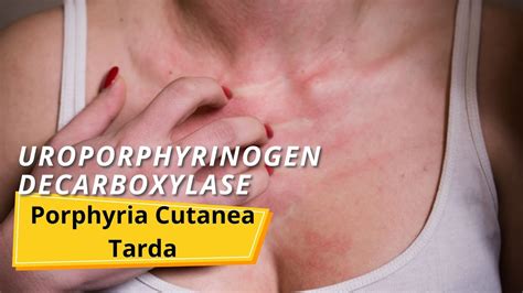 Porphyria Cutanea Tarda Pct Youtube