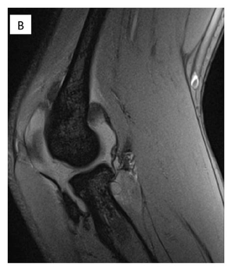 A Isolated Rupture Of The Anterior Medial Ulnar Collateral Ligament Download Scientific