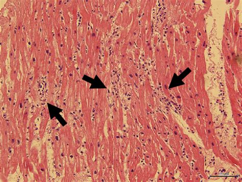 Figure5myocardial Biopsy Findings A Myocardial Biopsy Showing