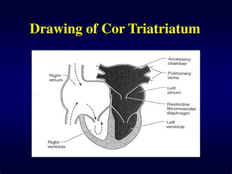 Ppt Cor Triatriatum Powerpoint Presentation Free Download Id645287