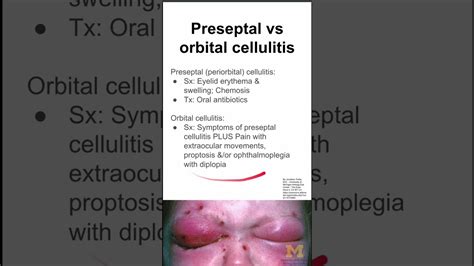 Preseptal Vs Orbital Cellulitis Youtube