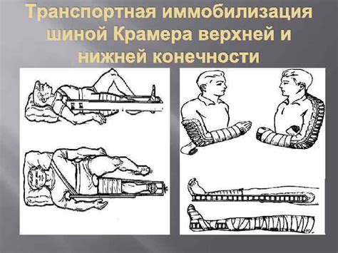 ПЕРЕЛОМЫ Переломы Переломы что это такое