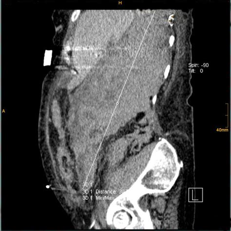 1st Case Ct Axial Plan Demonstrating A Retroperitoneal Hematoma