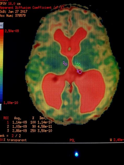 Radiodiagnóstico RMN Cerebral Hemorragia