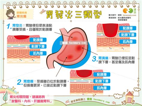 胃痛到爆！醫解析「發炎輕→重」分3類型拖太久小心變胃癌 Ettoday健康雲 Ettoday新聞雲