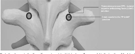 Figure From Freehand Thoracic Pedicle Screw Technique Using A Uniform