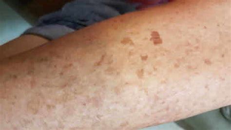 Liver Spots Causes