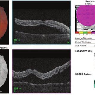 OCT scan of the right eye showing exudative retinal detachment prior to ...