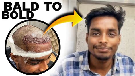 Bald To Bold Best Hair Transplant Result In India Best Hair