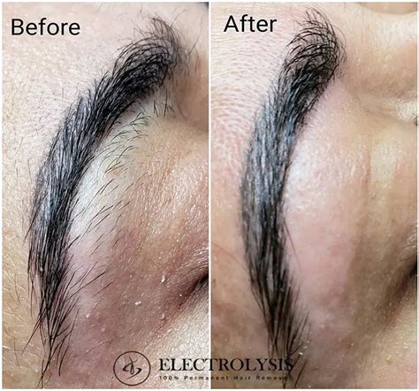 Electrolysis Before And After 100 Permanent Hair Removal