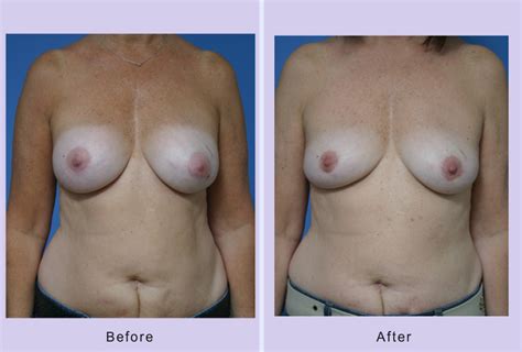 Breast Implant Removal Archives Anthony Youn MD FACS