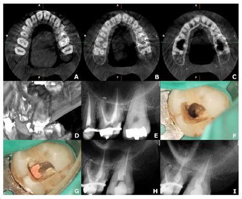 A Cbct Axial View Coronal Third B Cbct Axial View Middle Third Of