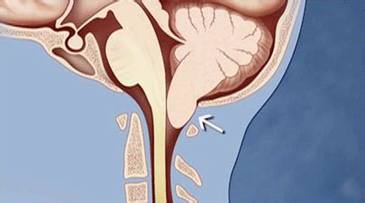 Pictures of Chiari | Weill Cornell Brain and Spine Center