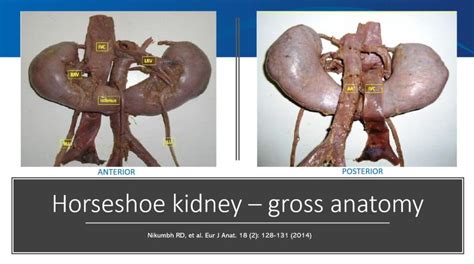 Horseshoe Kidney – NephroPOCUS