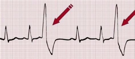 LEXTRASISTOLE VENTRICOLARE CHE COSE CAUSE DIAGNOSI E TERAPIA