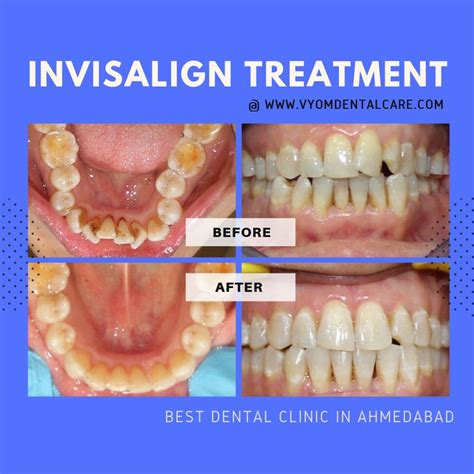 Invisalign Before And After Crowding Before And After